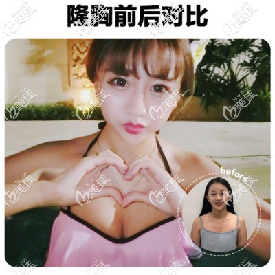 北京韓嘯棉花糖豐胸案例效果圖