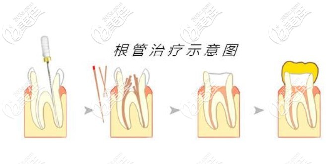 根管治療過(guò)程中痛是正常的嗎 根管治療過(guò)程中痛是正常的嗎
