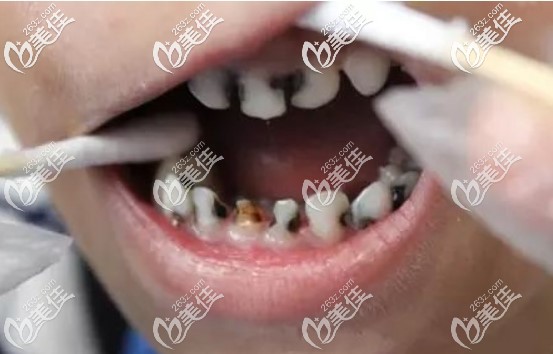 美奧口腔王文媛醫(yī)生建議孩子齲齒要早治療 美奧口腔王文媛醫(yī)生建議孩子齲齒要早治療