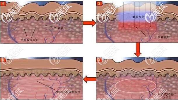 射頻緊膚的作用原理 射頻緊膚的作用原理