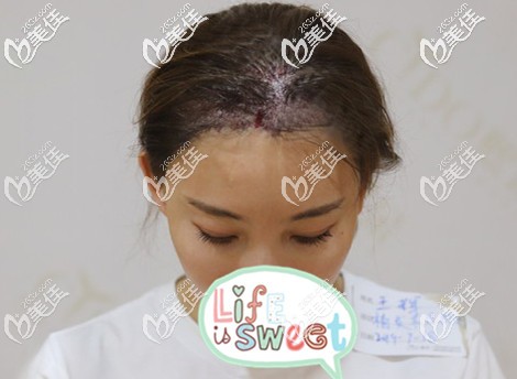 發(fā)際線種植術(shù)后即刻效果 發(fā)際線種植術(shù)后即刻效果