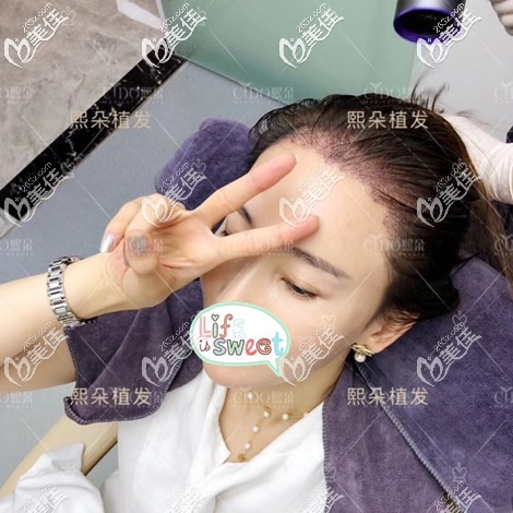 我是看了濟(jì)南熙朵院長(zhǎng)發(fā)際線種植一年效果圖覺(jué)得這家醫(yī)院超靠譜,才打聽(tīng)了醫(yī)院地址來(lái)手術(shù)的!