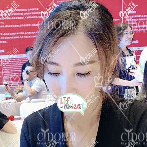 發(fā)際線種植1年效果圖 發(fā)際線種植1年效果圖