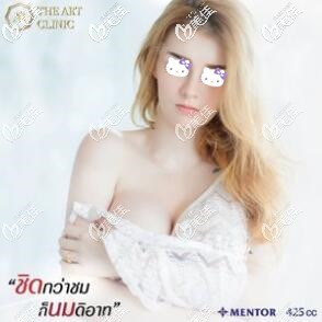 今天就把我在泰國藝術整形外科做的魔滴425cc假體隆胸真實恢復效果跟大家分享下！