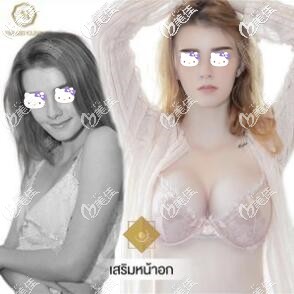 進(jìn)口假體隆胸術(shù)前術(shù)后對(duì)比照 進(jìn)口假體隆胸術(shù)前術(shù)后對(duì)比照