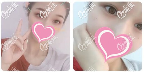 為什么割雙眼皮十個(gè)有九個(gè)后悔？個(gè)人做的雙眼皮開眼角恢復(fù)后效果圖不丑也不顯老