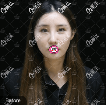 北京熱瑪吉哪家醫(yī)院好?我在北京美萊做四代熱瑪吉效果滿意 北京熱瑪吉哪家醫(yī)院好?我在北京美萊做四代熱瑪吉效果滿意