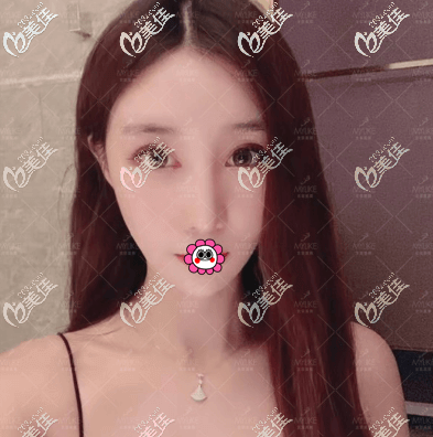 北京熱瑪吉醫(yī)院哪家好?我花2萬多找北京美萊劉崇醫(yī)生做第四代熱瑪吉效果滿意