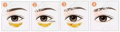 從技術(shù)原理來看不開刀去眼袋可靠不