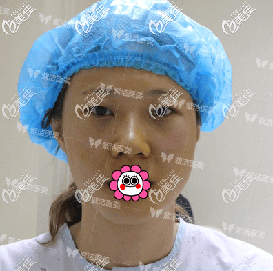 我做不開刀祛眼袋手術(shù)當(dāng)天