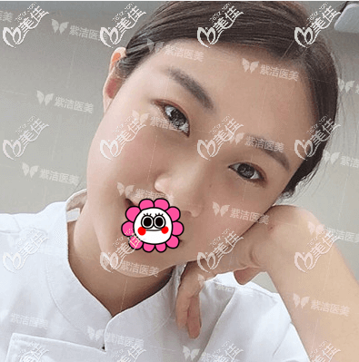 做不開刀祛眼袋二十天左右眼周肌膚平滑了