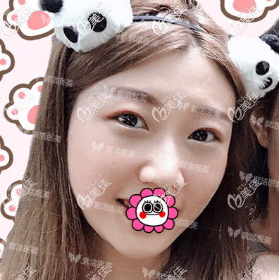 不開刀祛眼袋28天樣子