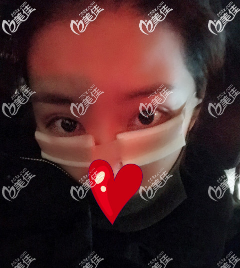 西安藝星去眼袋手術后當天照片 西安藝星去眼袋手術后當天照片