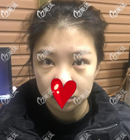 西安藝星去眼袋手術后第五天的樣子 西安藝星去眼袋手術后第五天的樣子