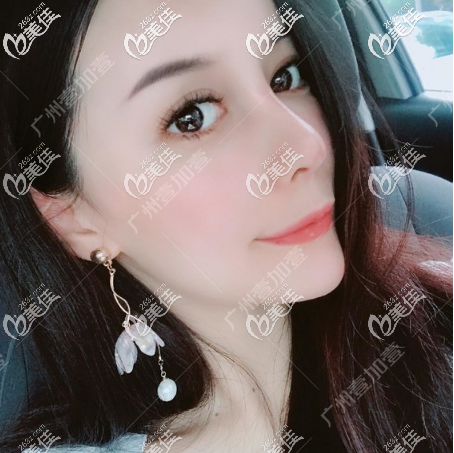 肋軟骨隆鼻一個月恢復效果 肋軟骨隆鼻一個月恢復效果