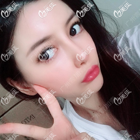 為什么建議大家不要隆鼻?我就一點(diǎn)也不后悔做了肋軟骨隆鼻