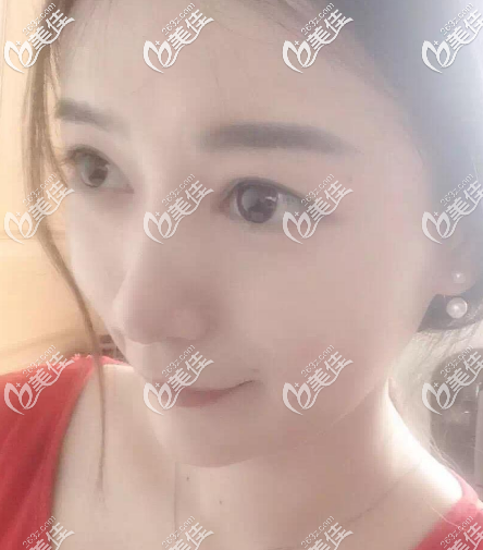 找廣州壹加壹李明隆鼻術前照片 找廣州壹加壹李明隆鼻術前照片