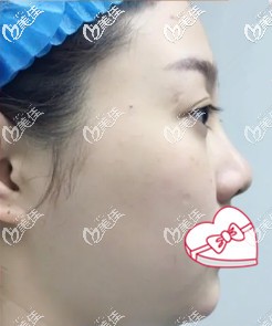 術前我的臉比較大還肥 術前我的臉比較大還肥