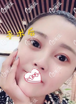 看到術(shù)后第五天臉越來越腫挺后悔做面部光纖溶脂的 誰知恢復22天就告別了嘟嘟肉臉