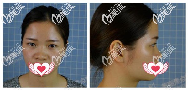 鼻修復(fù)手術(shù)前 鼻修復(fù)手術(shù)前