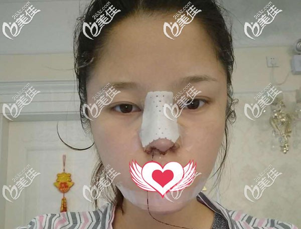 做完隆鼻當天呼吸不順暢 做完隆鼻當天呼吸不順暢