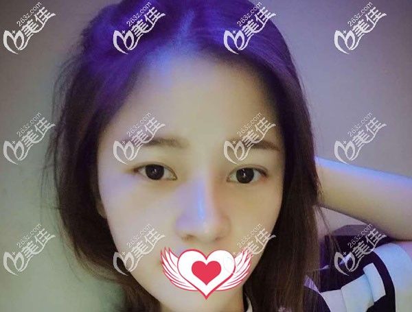 鼻修復(fù)手術(shù)一個月鼻背線條流暢 鼻修復(fù)手術(shù)一個月鼻背線條流暢