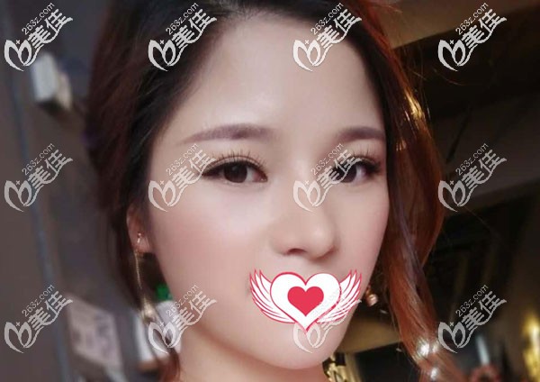 隆鼻失敗做修復(fù)到底肋骨鼻好還是耳軟骨好，我4個月恢復(fù)效果給你答案