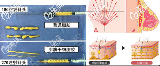 廣東美恩顧榮脂肪填充技術(shù) 廣東美恩顧榮脂肪填充技術(shù)