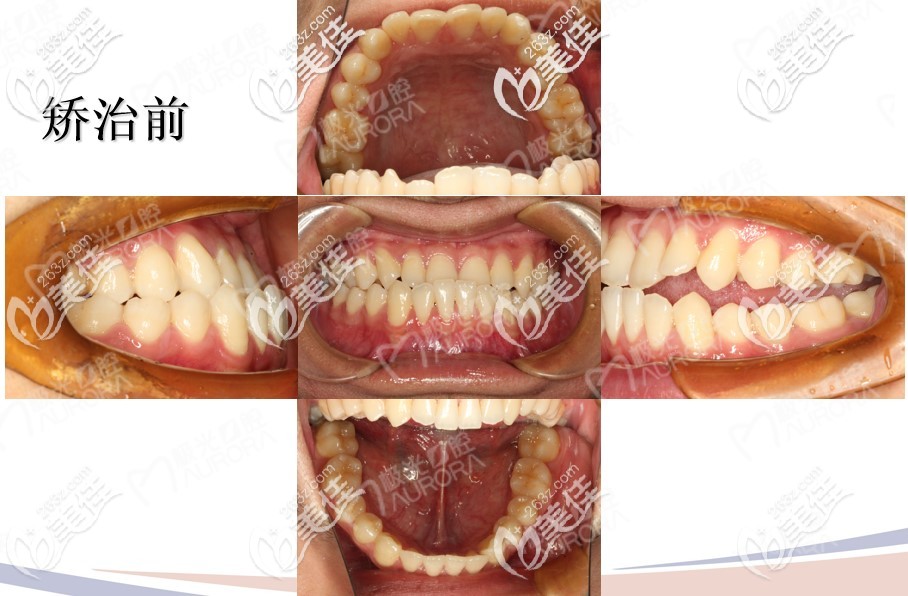 在成都極光口腔矯正地包天前牙齒情況