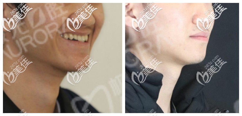 23歲骨性地包天帶牙套好了，我真的只找成都極光口腔醫(yī)生游學(xué)敏矯正了牙齒沒做正頜手術(shù)