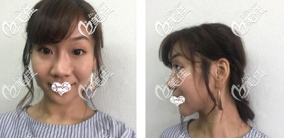 術(shù)前鼻子寬大 術(shù)前鼻子寬大