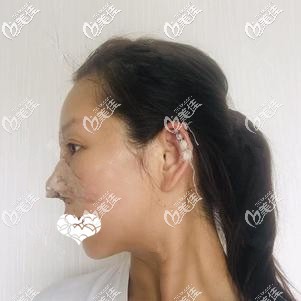 剛做完自體軟骨隆鼻術(shù)后鼻子腫脹 剛做完自體軟骨隆鼻術(shù)后鼻子腫脹