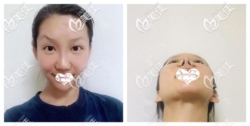 鼻綜合術(shù)后10天鼻子拆線 鼻綜合術(shù)后10天鼻子拆線