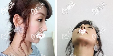 綜合鼻整形術(shù)后鼻子微腫 綜合鼻整形術(shù)后鼻子微腫