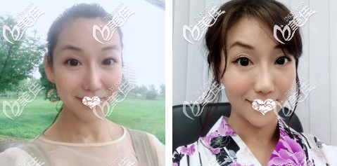 自體軟骨隆鼻術(shù)后1個月完全消腫 自體軟骨隆鼻術(shù)后1個月完全消腫