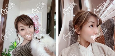 你們所擔(dān)心的自體軟骨隆鼻后會變彎曲、移位、露鼻孔問題 找酒井直彥做鼻綜合是不存在的