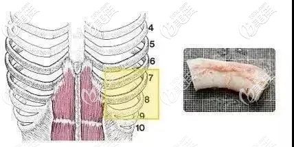 肋軟骨隆鼻是否會(huì)彎曲的詳細(xì)說明 肋軟骨隆鼻是否會(huì)彎曲的詳細(xì)說明