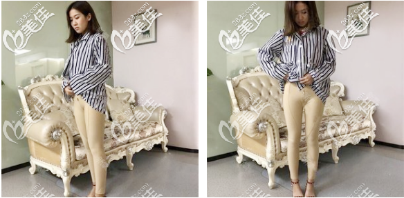 在佛山華美做完大腿吸脂4天圖片