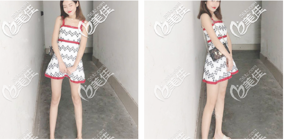 看佛山華美梁宗建大腿吸脂效果怎么樣