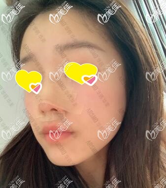 鼻整形術(shù)后1周效果圖