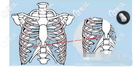 肋軟骨隆鼻取材示意圖 肋軟骨隆鼻取材示意圖