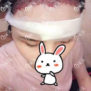 發(fā)際線種植術后即刻紅腫