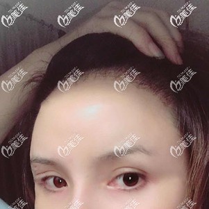 發(fā)際線種植術后37天生長出新毛發(fā)