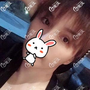 都說做完發(fā)際線覺得不自然，但像我這一直后溜的發(fā)際線再不做種植就要變“禿了”