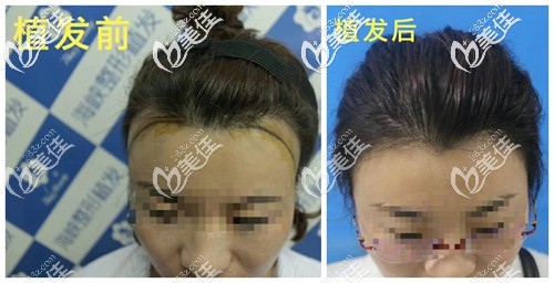我做發(fā)際線種植四個(gè)月的效果 我做發(fā)際線種植四個(gè)月的效果