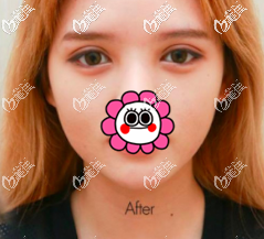 這是我在泰國(guó)做切開雙眼皮的手術(shù)經(jīng)歷,順便和你說(shuō)說(shuō)泰國(guó)哪家做雙眼皮好