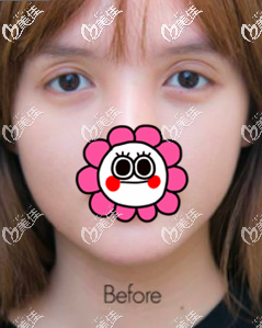 我在泰國做雙眼皮前 我在泰國做雙眼皮前