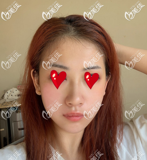 西安米蘭柏羽自體脂肪填充面部術(shù)后第十五天 西安米蘭柏羽自體脂肪填充面部術(shù)后第十五天