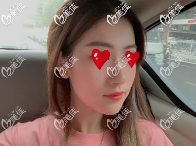 西安米蘭柏羽自體脂肪填充面部術(shù)后第20天 西安米蘭柏羽自體脂肪填充面部術(shù)后第20天