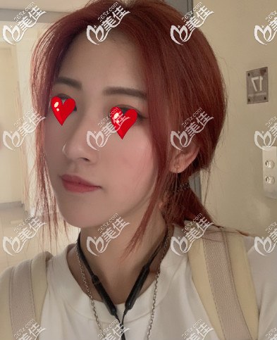 很中肯的說(shuō)西安米蘭柏羽自體脂肪填充面部恢復(fù)到15天的時(shí)候都很驚人了